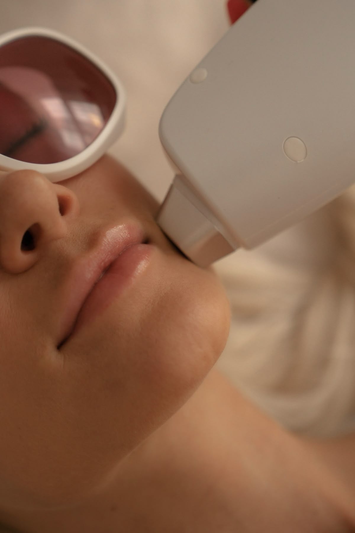 Epilazione laser a diodo